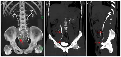 Long segment ureterectomy with tapered demucosalized ileum replacement of ureter for ureteral cancer: a case report and literature review